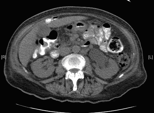 Figure 1: Moderate left renal hydronephrosis due to abscess obstructing the ureter